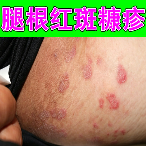 大腿内侧痒起红斑干燥粗糙起皮掉屑专用男士私处潮湿玫瑰糠疹软膏