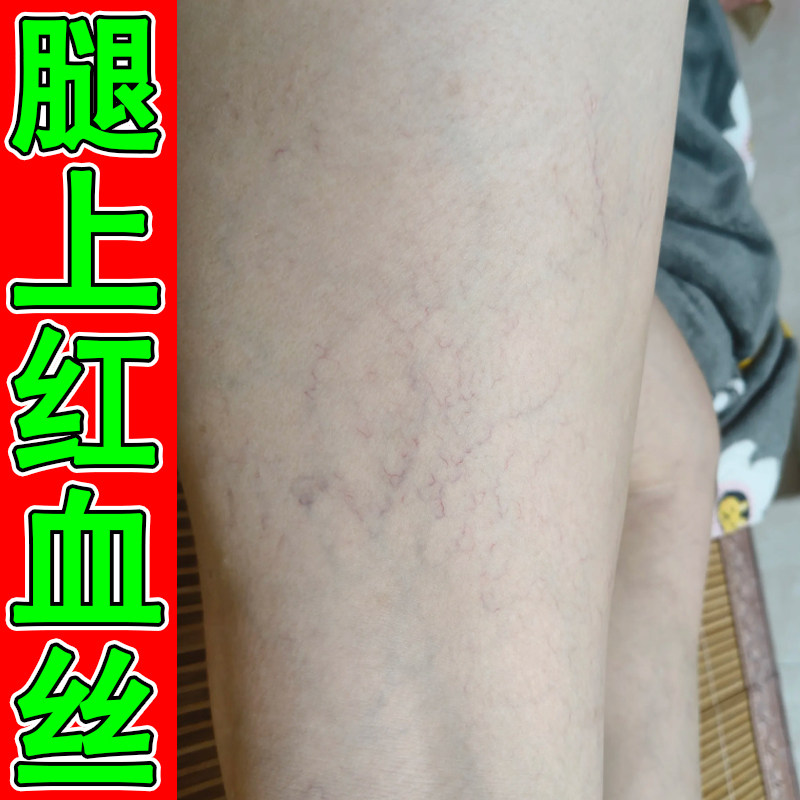 腿上有红血丝修复药久站久坐血液不流畅毛细血管扩张腿部红血丝