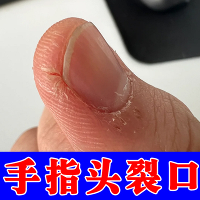 手指头裂口子干燥粗糙起皮掉屑指甲缝周围开裂疼痛手脚干裂修复霜