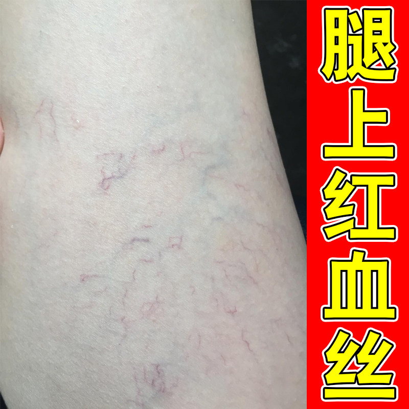 腿上有红血丝青筋凸起毛细血管扩张腿部酸血丝腿外用修复软膏