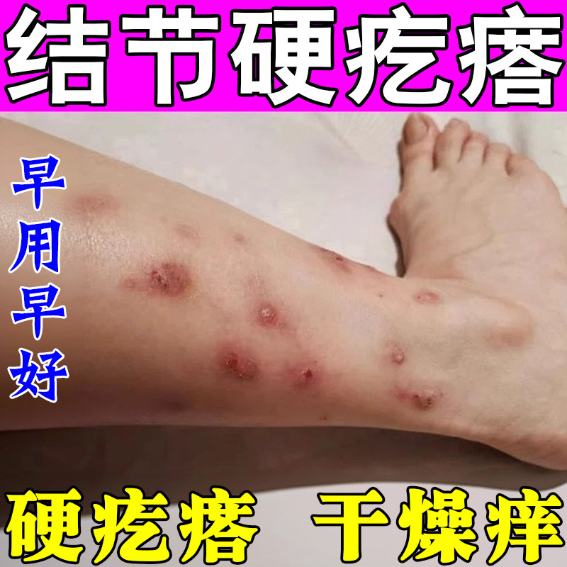 【小腿去硬结】结节性痒疙瘩冶顽固硬疙瘩胳膊小腿痒皮肤干燥粗糙