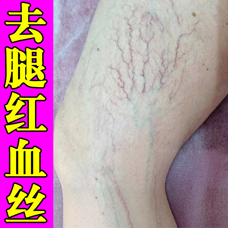 腿上有红血丝静脉冷敷凝胶官方正皮肤消毒护理（消）