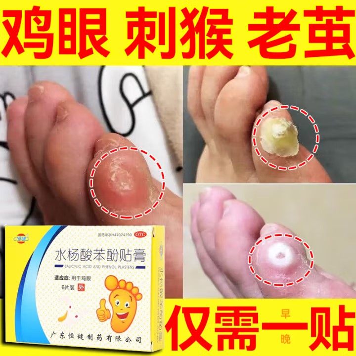 恒健水杨酸苯酚贴膏除鸡眼贴刺猴老茧根软化角质去死皮治鸡眼贴膏