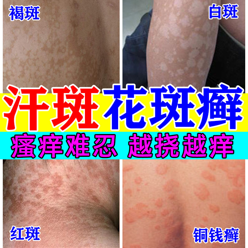 汗斑花斑癣专用药膏治疗花斑癣铜钱癣真菌感染手足体癣股藓去斑癣