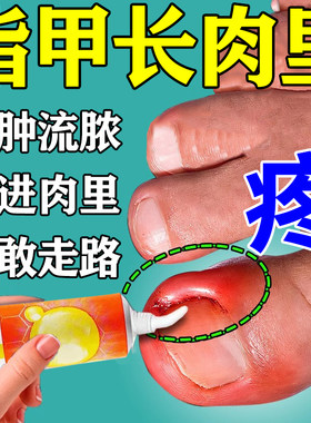 【立可舒】醋酸曲安奈德益康唑乳膏18g*1支/盒