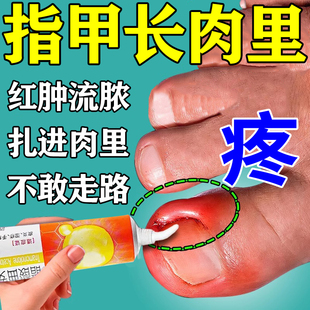 治疗甲沟炎的专用药膏指甲往肉里长特消肿去肉芽息肉消炎化脓效药