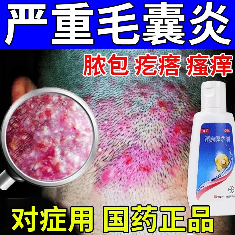 【敬宇】酮康唑洗剂2%*50ml/瓶