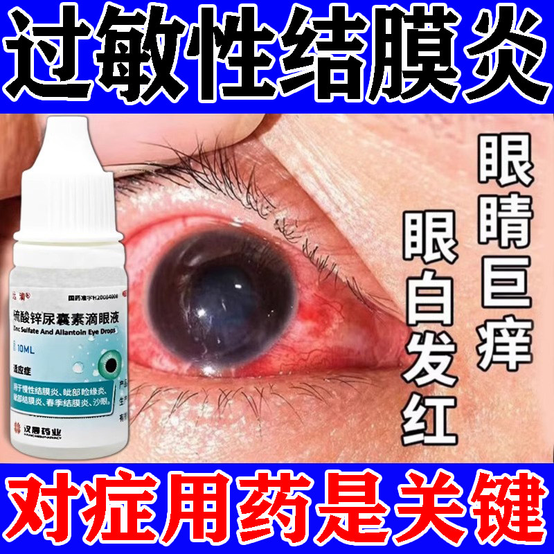 过敏性结膜炎滴慢性眼液鼻炎引起眼睛痒眼角痒干涩消炎止痒眼药水