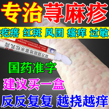 治疗荨麻疹过敏止痒断特用专根效药膏皮肤瘙痒风团起红疹抗过敏药