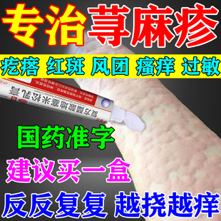 治疗荨麻疹过敏止痒断特用专根效药膏皮肤瘙痒风团起红疹抗过敏药