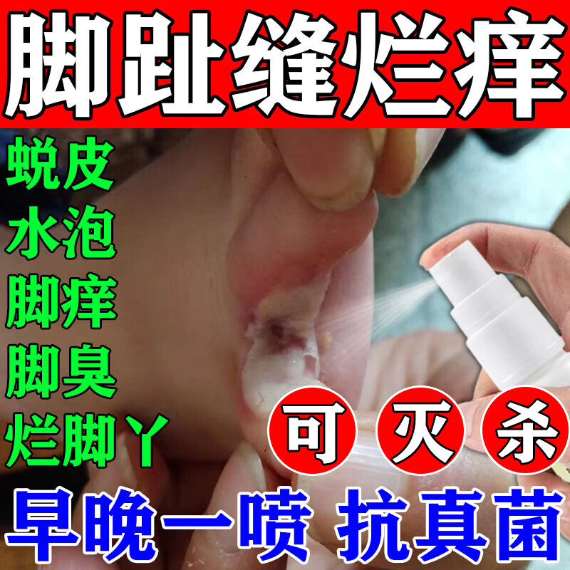 脚气喷雾止痒脱皮真菌感染杀菌专用去药特根效药烂脚丫药糜烂脚趾