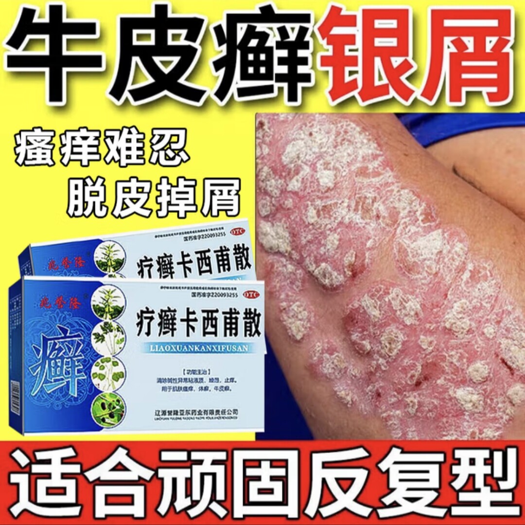 疗癣卡西甫散主治牛皮癣口服药皮肤瘙痒红肿脱屑反复治癣止痒中药