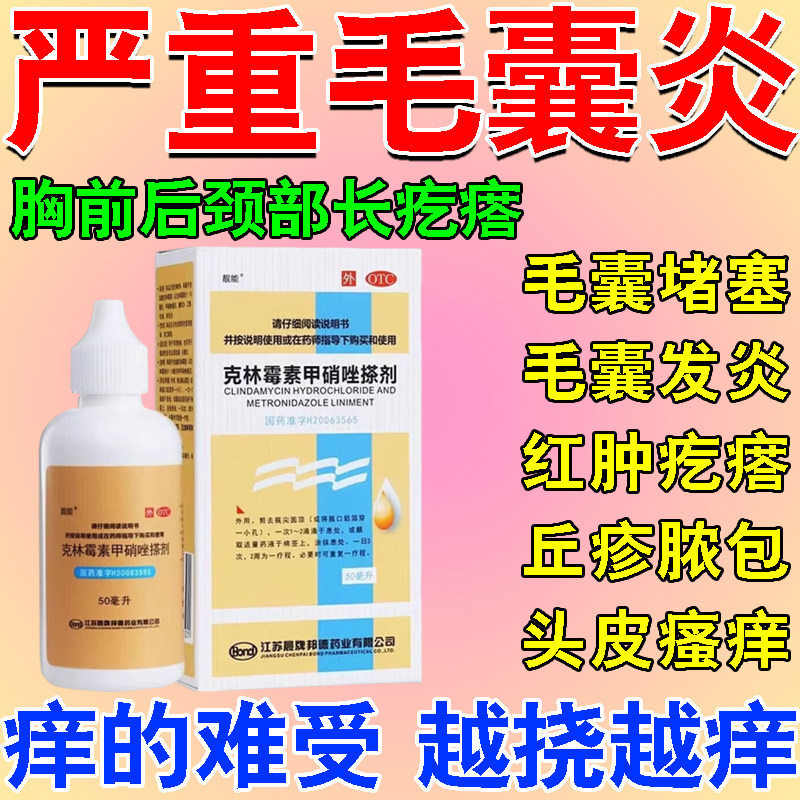 头皮毛囊炎特新药效治疗马拉色菌头部专用药膏克林霉素甲硝唑搽剂