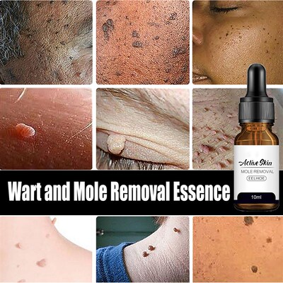 新品Free Shipping Wart Treatment Wart Removal Essence Neck S