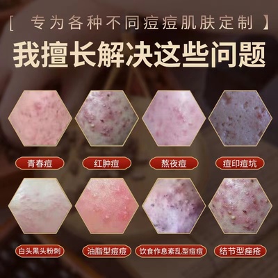 新品下巴反复脸上长痘痘用什么药淋巴腮边痘红肿结节硬块痘玫瑰痤