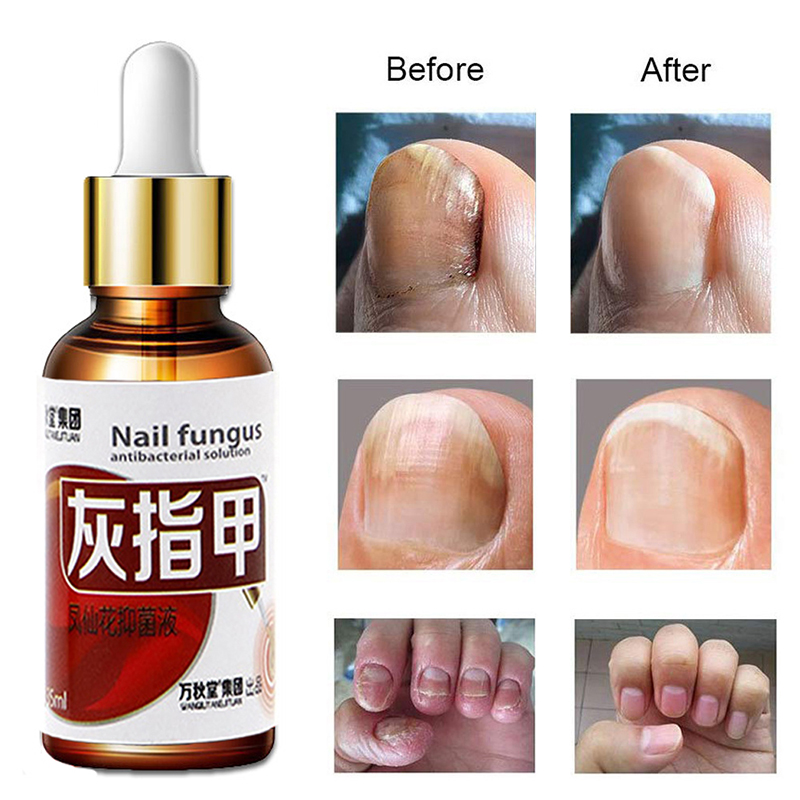 Nail Fungal Treatment Feet Care Essence Against Fungal Nail