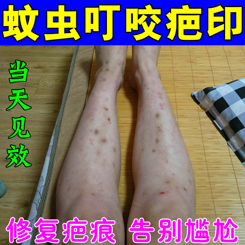 蚊虫叮咬祛疤f膏去蚊子叮咬疤痕印腿上淡化黑色素修复腿印挠印痘