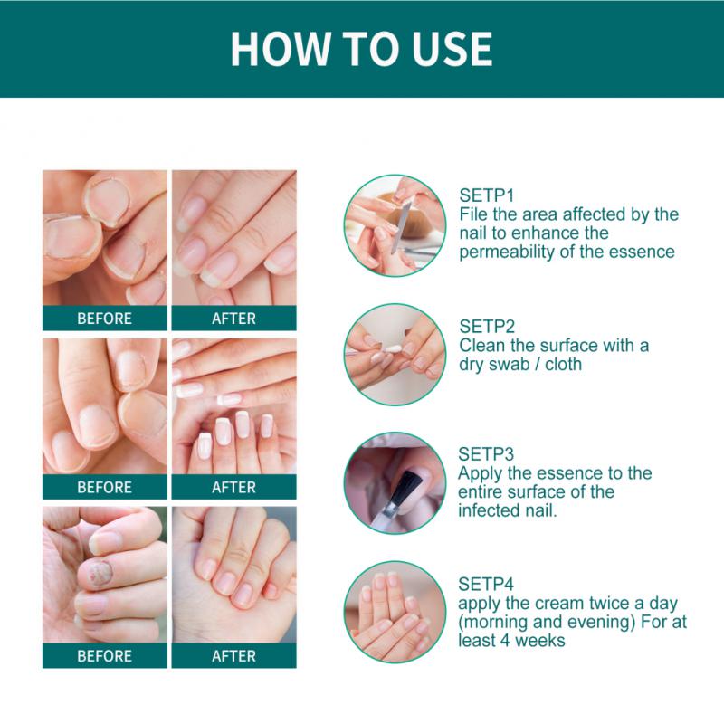 Prego cura fungosa remo??o do fungo do prego lquido nutr