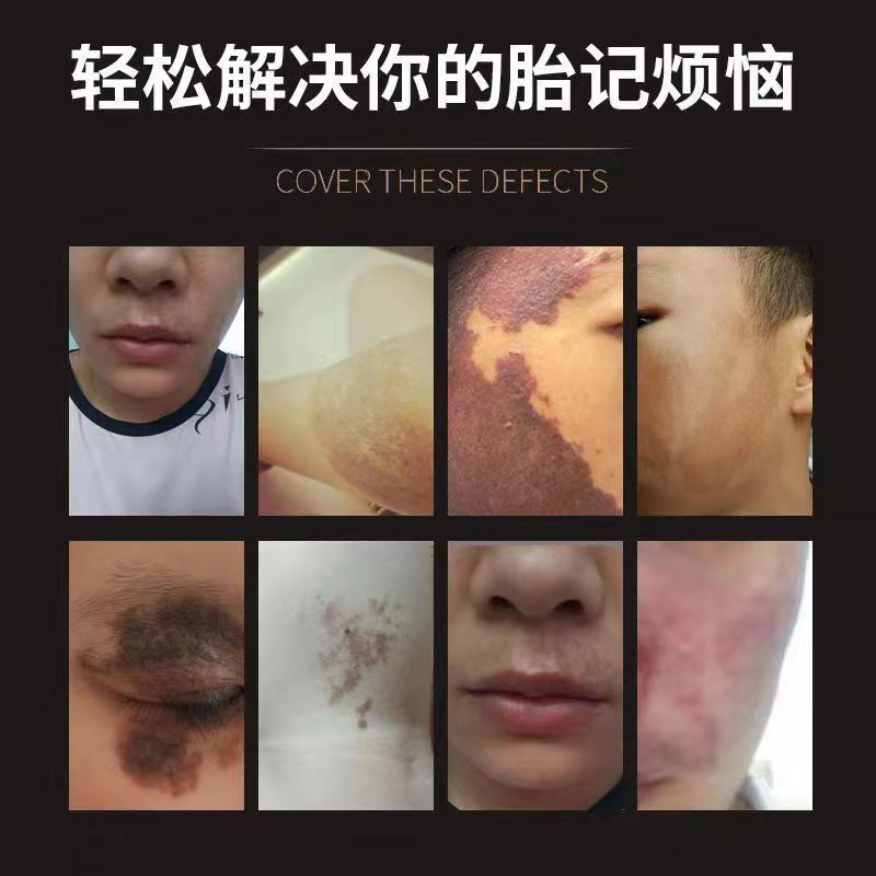 胎记去除膏【三天全消】脸部咖啡斑淡化黑色素太田痣遮盖消除神器