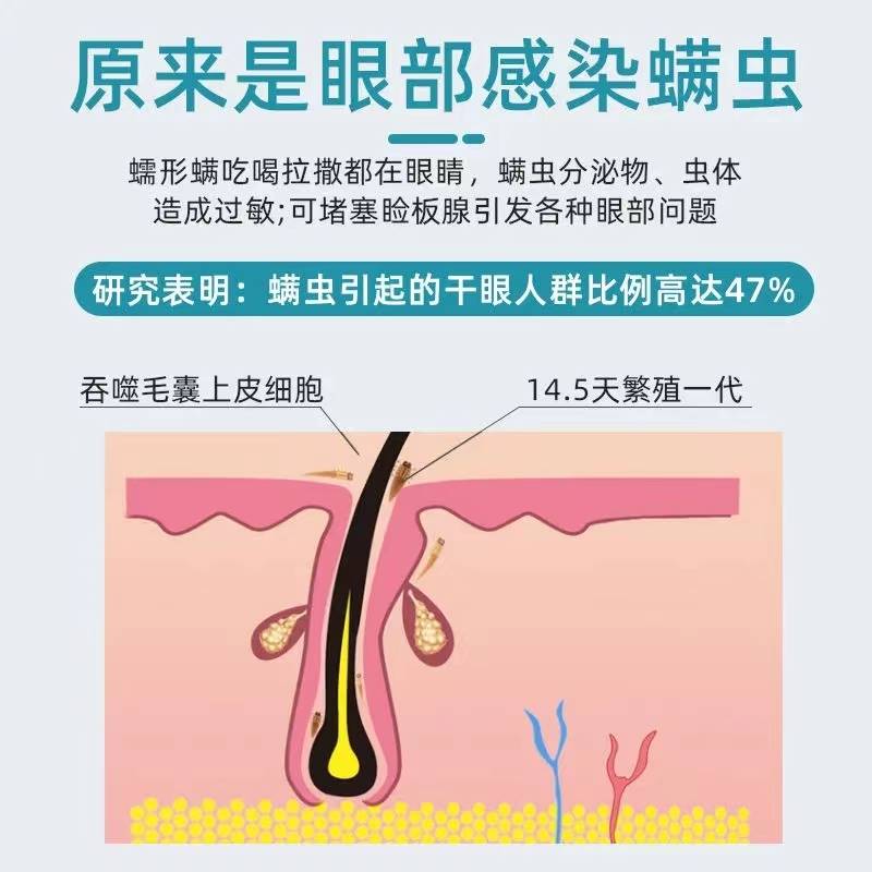 眼睛除螨洗眼液眼部专用叶黄素眼干涩发痒充血过敏螨虫清洁除螨