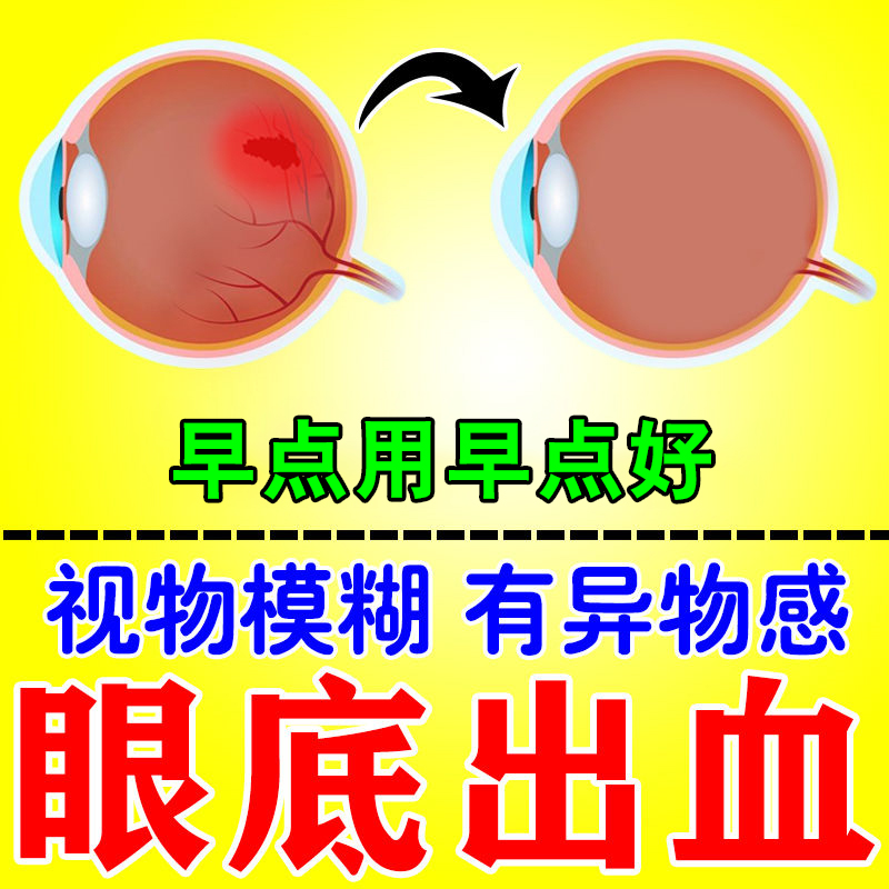 眼底出血有异物感眼部红血丝视物重影模糊眼干酸叶黄素滴眼液