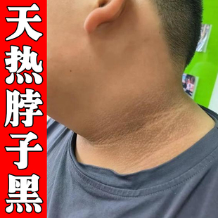 脖子黑春夏天气热身上皮肤晒黑儿童黑棘皮膝盖关节手肘黑色素沉淀
