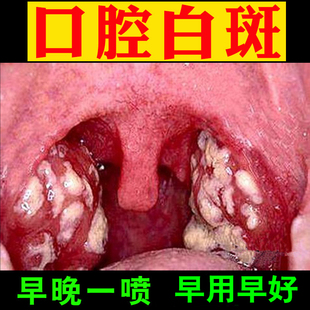 口腔黏膜声带白斑疼痛喉咙有异物草本修复喷剂