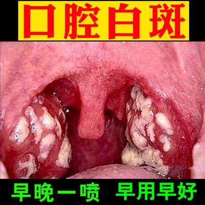 口腔黏膜声带白斑疼痛喉咙有异物草本修复喷剂