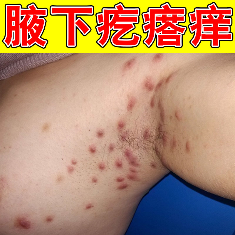 腋下长疙瘩痒身上痒腋窝燥粗糙长小红点痒外用膏身上痒