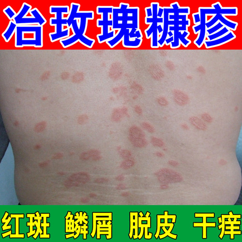 身上长红斑干燥掉皮屑痒圆斑鳞屑