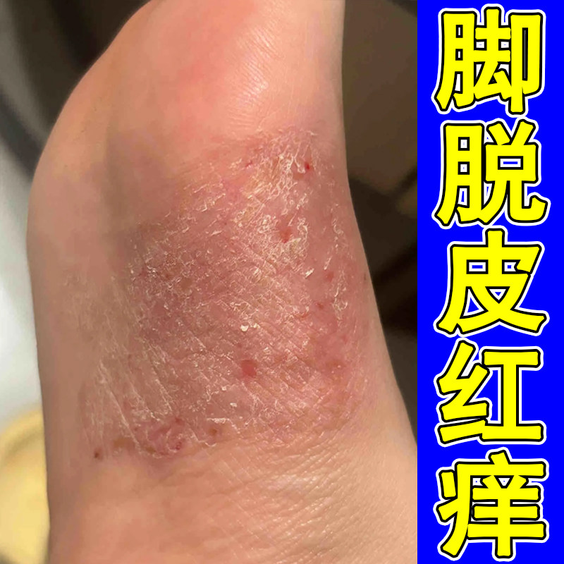 脚脱皮红痒脚底起小水泡干燥粗糙脚底掉皮屑起干皮手脚蜕皮外用膏