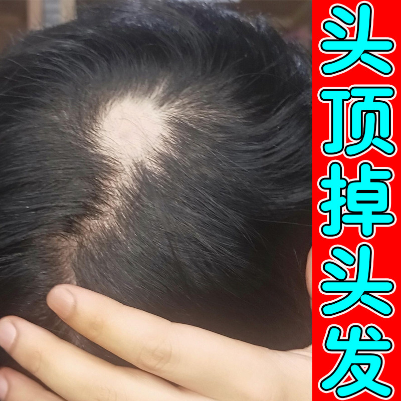 儿童斑秃鬼剃头药小孩子专用生发剂增发激活毛囊受损