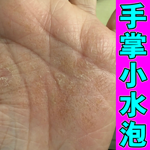 手背痒修复手面上长红疙瘩小孩子手上起水泡皮肤过敏干燥掉皮