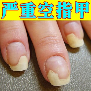 专治空指甲修复手指甲肉甲床分离发黄变空真菌性白甲受损再生