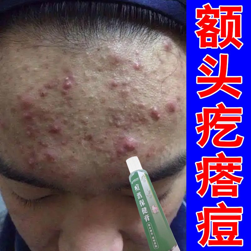 额头痘小疙瘩粉刺闭口脸部的星脸皮肤消毒护理（消）