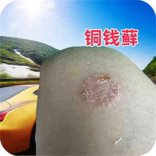 人患猫圈大钱疮铜钱圈金钱圈大圆圈顽固环状圈胳膊痒皮痒圆形圈