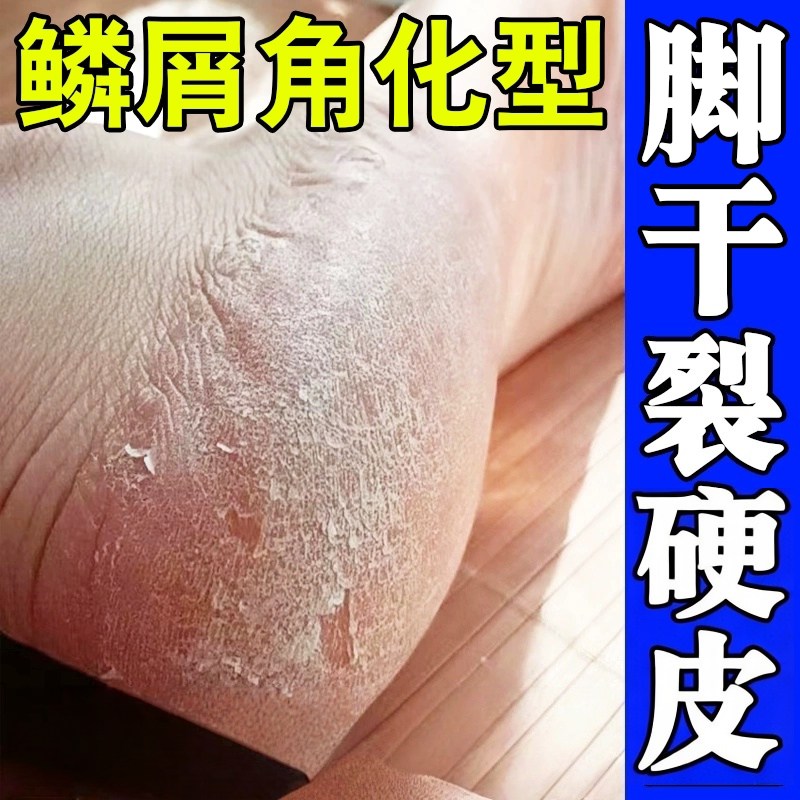 脚后跟干裂真菌起硬皮足跟开裂起皮修复霜脚底痒修护膏