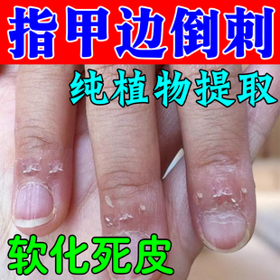 去手指倒刺修复软膏手上长刺干燥脱皮起硬皮粗糙裂纹软化嫩肤膏