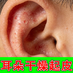 耳朵痒耳廓痒干起燥皮耳朵里面痒用真流菌解脓痒结痂专用