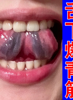 舌下爆青筋舌根青筋又黑又粗口腔溶栓液治舌根处疼痛血管发紫喷剂