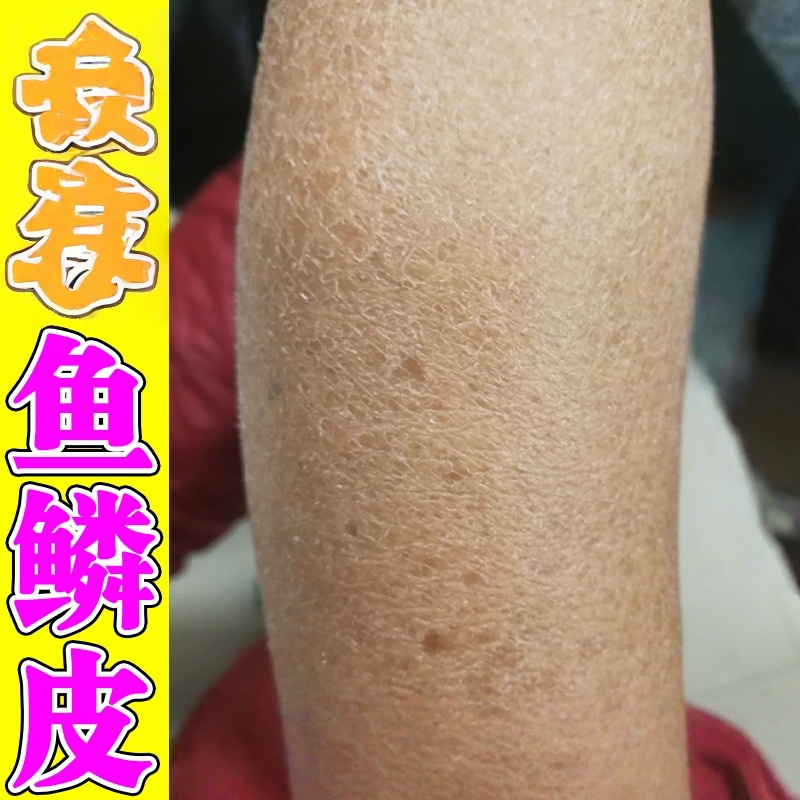 鱼鳞皮肤霜去鸡蛇皮肤专用乳腿上干燥痒起皮屑脱皮身体乳液