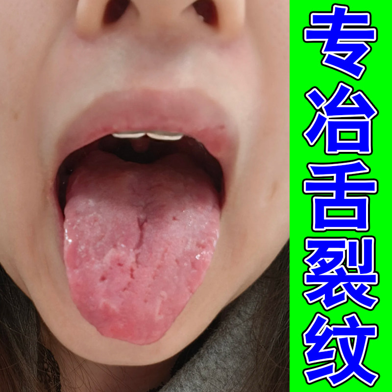 舌头裂纹有齿痕口干苦舌苔白厚黄皮肤消毒护理（消）