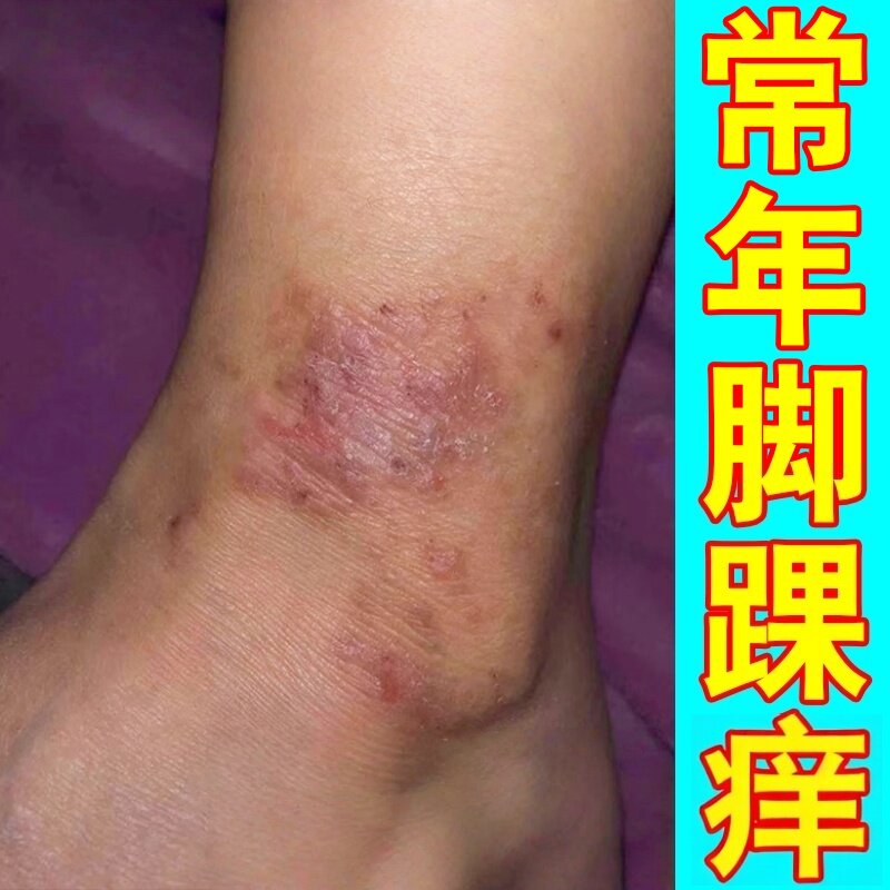 脚踝痒脚脖子痒脚面脚背干燥脚起红斑顽固性足痒真菌膏