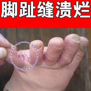 脚指缝溃烂脚趾缝烂脱皮开裂口烂脚子裂口开裂起皮脚趾缝起泡