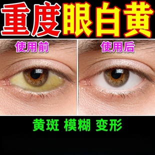眼白发黄眼睛清澈去黄去红血丝眼药水修复巩膜黄染黄斑变滴眼液