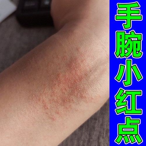 手腕红点痒红痒身上痒起红疙瘩换季皮肤干燥粗糙红肿干痒修复软膏