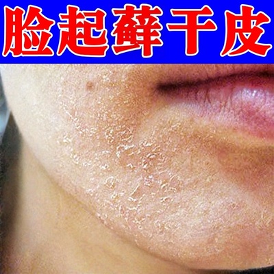 脸起皮干燥有碎屑修复霜脸部皮肤干燥红痒嘴角下巴起鲜过敏脱皮液