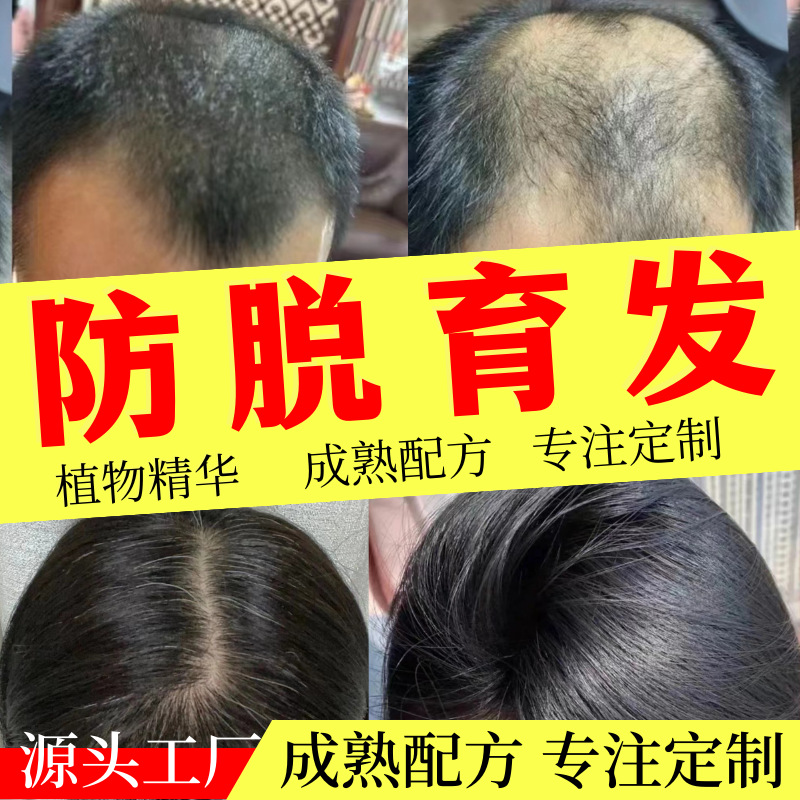 生发液育发液增发液生发液防脱育发精华液增长发密发育发何首乌