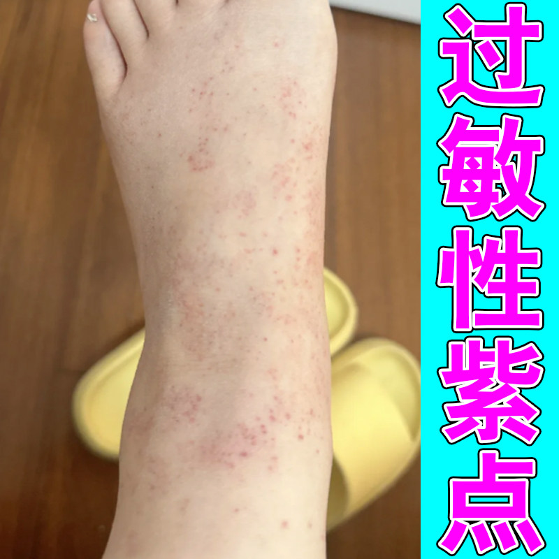 冶胳膊腿上莫名紫红点斑块皮下透出斑驳印记躯干散在瘀点肌肤表层