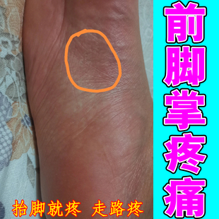 前脚掌疼痛专用膏脚底板疼痛脚掌筋膜疼走路疼脚掌肿胀酸痛麻